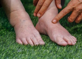 Como aliviar a Retenção de Líquido e o inchaço de forma rápida e eficaz