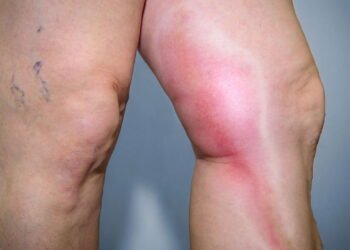 Silenciosa, mas mortal, o alerta urgente sobre a Trombose que você precisa ler!