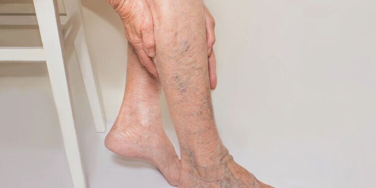 Trombose - Créditos: depositphotos.com / Marina113