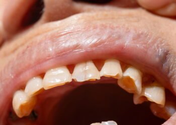 Dentes desgastados? Veja o que pode estar causando
