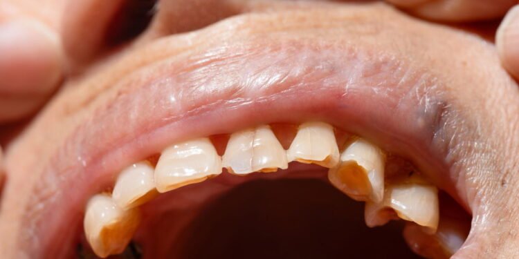 Desgaste dos dentes - Créditos: depositphotos.com / toa55