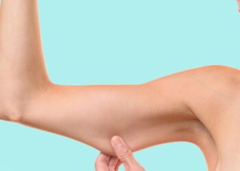 Dicas caseiras para tratar a Flacidez após perda de peso