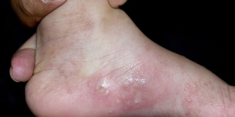 Bolhas nos pés- Créditos: depositphotos.com / zaynyinyi