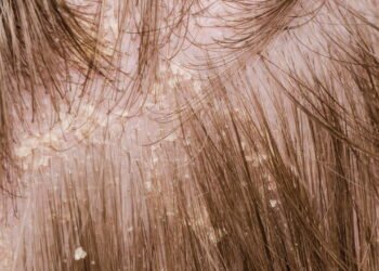 Adeus Caspa o método caseiro que está surpreendendo todos