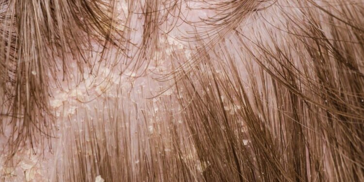 Caspa - Créditos: depositphotos.com / roblan