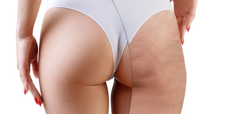 Celulite - Créditos: depositphotos.com / kotin