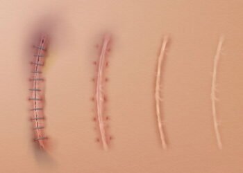 Dicas para uma Cicatrização mais rápida e eficiente