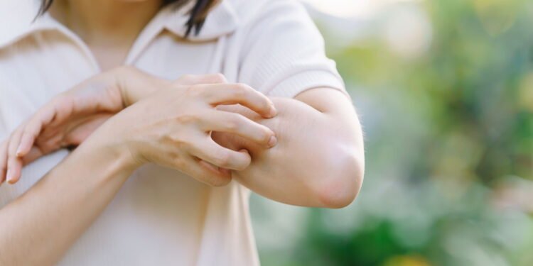 Coceira - Créditos: depositphotos.com / Oporty