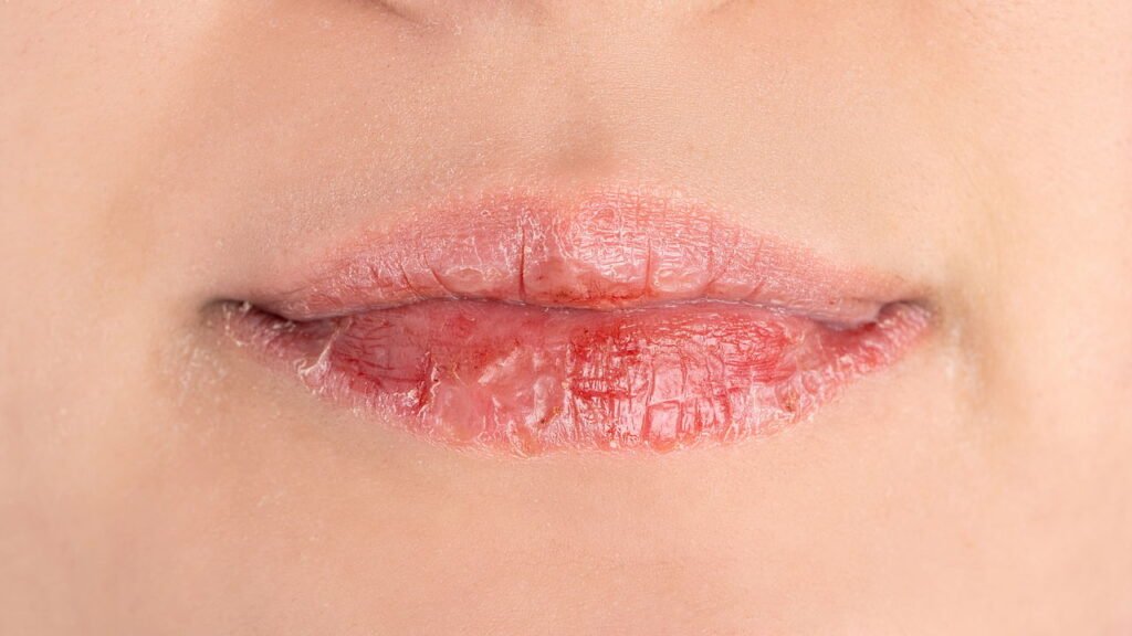 O que significa ficar puxando as pelezinhas dos lábios e machucar?