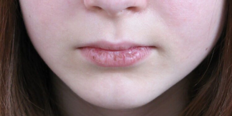Lábios rachados -Créditos: depositphotos.com / roman101