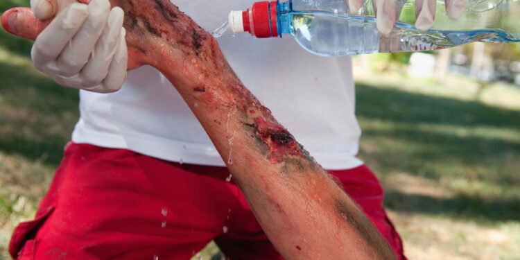 Queimadura - Créditos: depositphotos.com / microgen