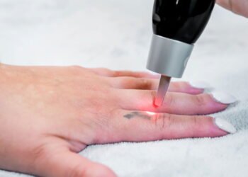 Por que jovens estão removendo Tatuagens?