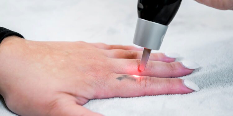 Removendo tatuagem -Créditos: depositphotos.com / thoughtsofjoyce