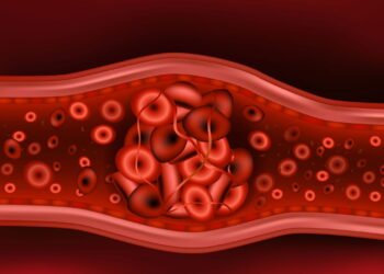 Saiba como prevenir Coágulos Sanguíneos com hábitos simples