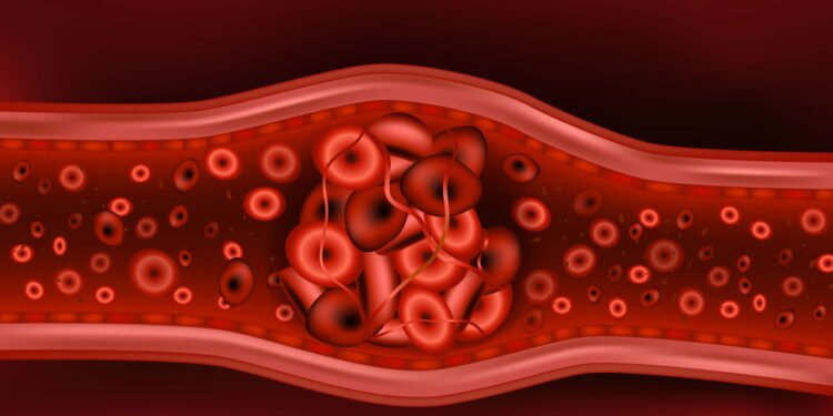 Coágulos Sanguíneos - Créditos: depositphotos.com / Sakurra