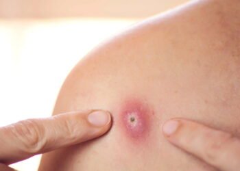 Foliculite tem cura? Veja tratamentos eficazes