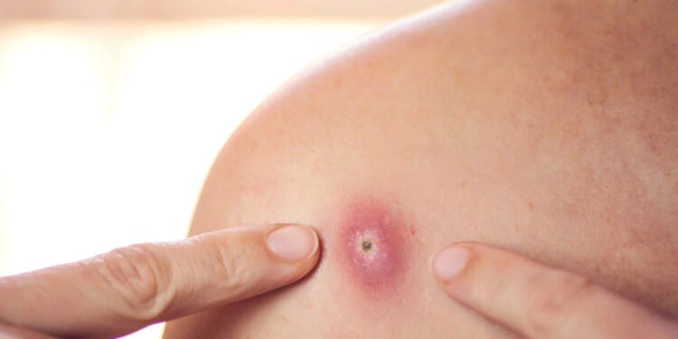 Foliculite - Créditos: depositphotos.com / dexteris