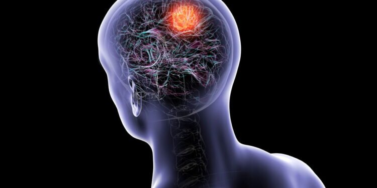 tumor cerebral - Créditos: depositphotos.com / katerynakon