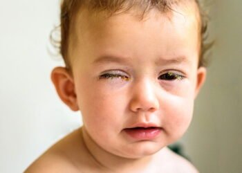 Remela nos olhos pode esconder algo mais sério