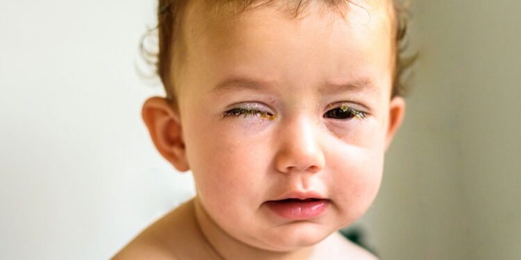 Remela - Créditos: depositphotos.com / joaquincorbalan