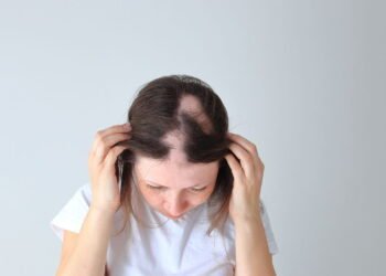 O que é alopecia areata e como tratar a queda de cabelo