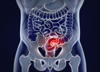 Maneiras eficazes de reduzir o risco de câncer colorretal