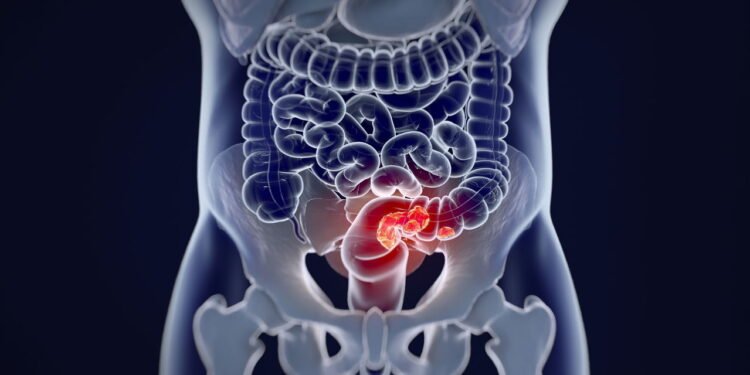 Maneiras eficazes de reduzir o risco de câncer colorretal