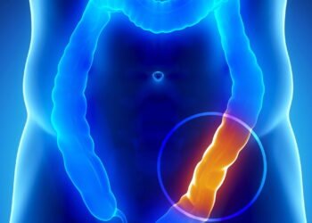 Cinco sinais comuns do câncer de cólon que muitas vezes são ignorados