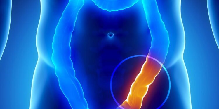 Cinco sinais comuns do câncer de cólon que muitas vezes são ignorados