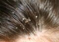 Dicas caseiras para acabar com a Caspa de uma vez por todas