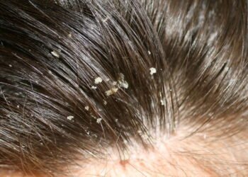 Dicas caseiras para acabar com a Caspa de uma vez por todas
