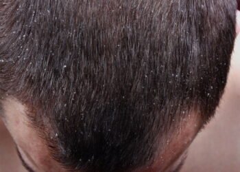 Dicas caseiras para acabar com a Caspa de uma vez por todas