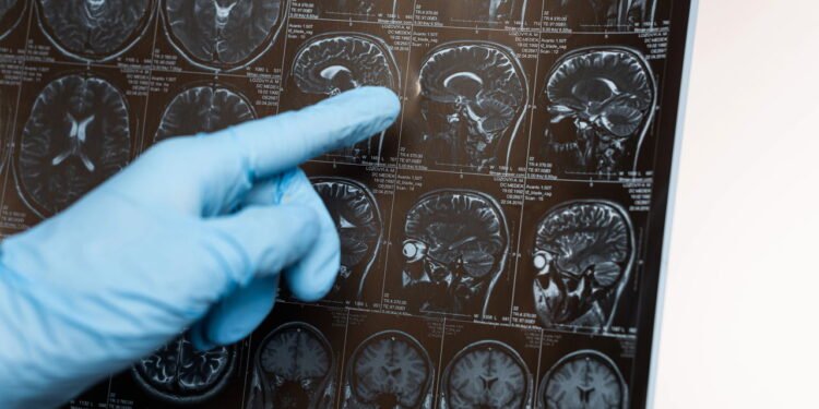 Novo estudo alarmante revela fator negligenciado que pode levar a tumores cerebrais