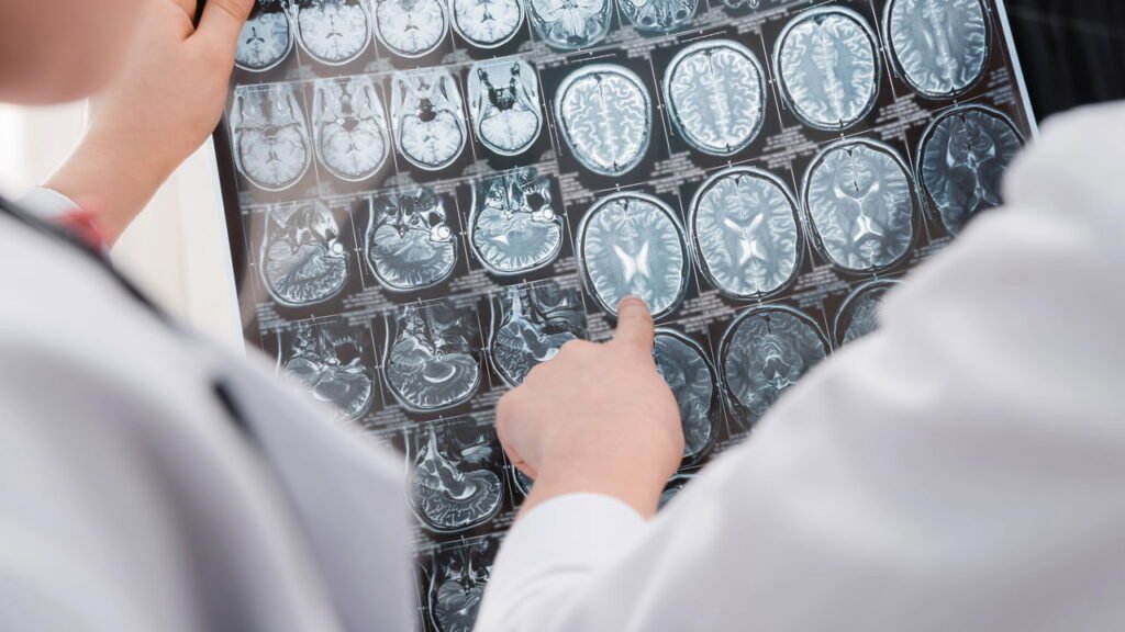 Novo estudo alarmante revela fator negligenciado que pode levar a tumores cerebrais