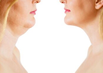 Como tratar a flacidez no pescoço e recuperar firmeza rapidamente