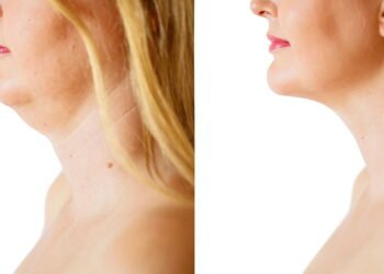 Como tratar a flacidez no pescoço e recuperar firmeza rapidamente