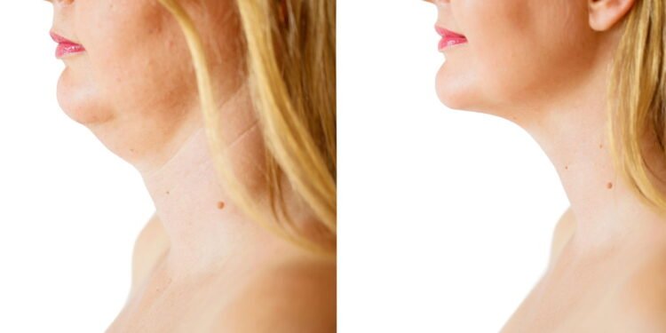 flacidez pescoço - Créditos: depositphotos.com / grinvalds