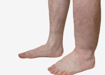 Dra. Andréa Klepacz, Cirurgiã: Inchaço nas Pernas pode revelar algo muito mais sério 