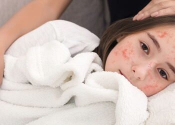 EUA registram aumento recorde de casos de sarampo em 2025