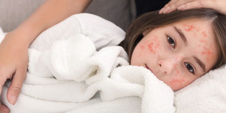 Sarampo - Créditos: depositphotos.com / Milkos