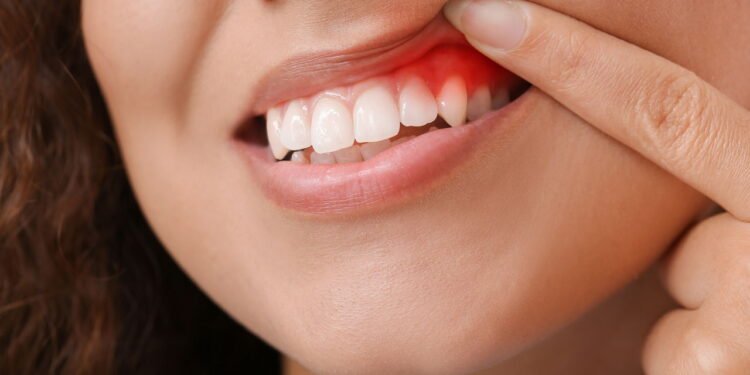 Gengiva vermelha pode indicar inflamação séria - Créditos: depositphotos.com / serezniy