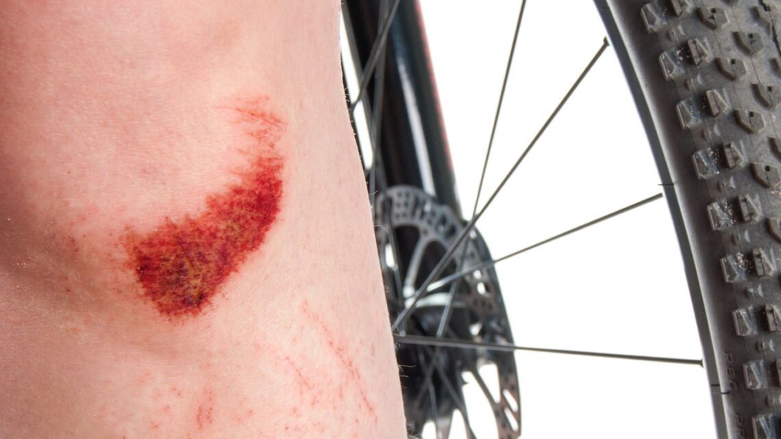 Caiu de moto ou bike? Veja como tratar o ralado - Correio Braziliense ...