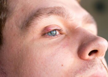 Dra. Tayuane Pinto, Oftalmologista: Blefarite é contagiosa? Entenda tudo sobre a condição