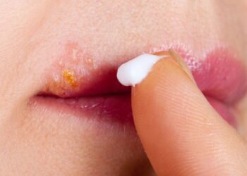 Melhores pomadas para herpes labial para um alívio mais rápido