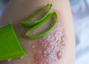 Como agir em caso de queimadura para amenizar os danos