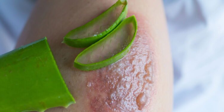 Queimaduras - Créditos: depositphotos.com / weerameth