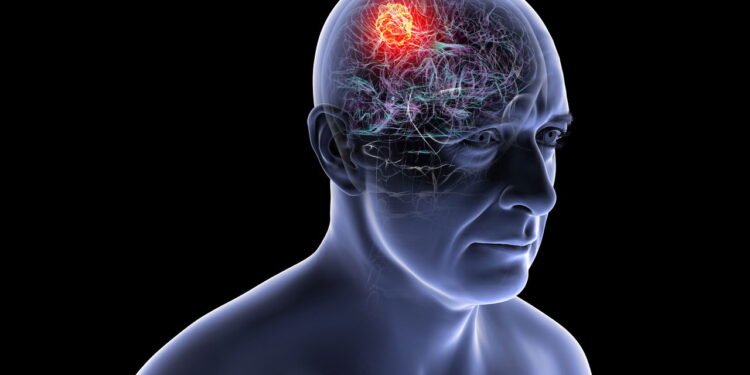 Tumores Cerebrais - Créditos: depositphotos.com / katerynakon