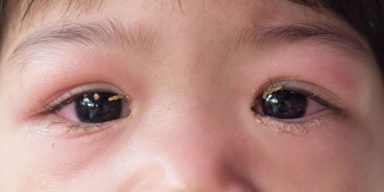 Blefarite - Créditos: depositphotos.com / nikonlike