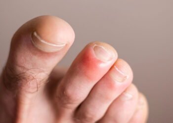 Remédios caseiros para acabar com sua Friera de uma vez