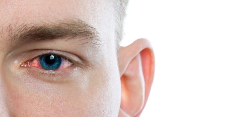 Olho irritado - Créditos: depositphotos.com / jutar